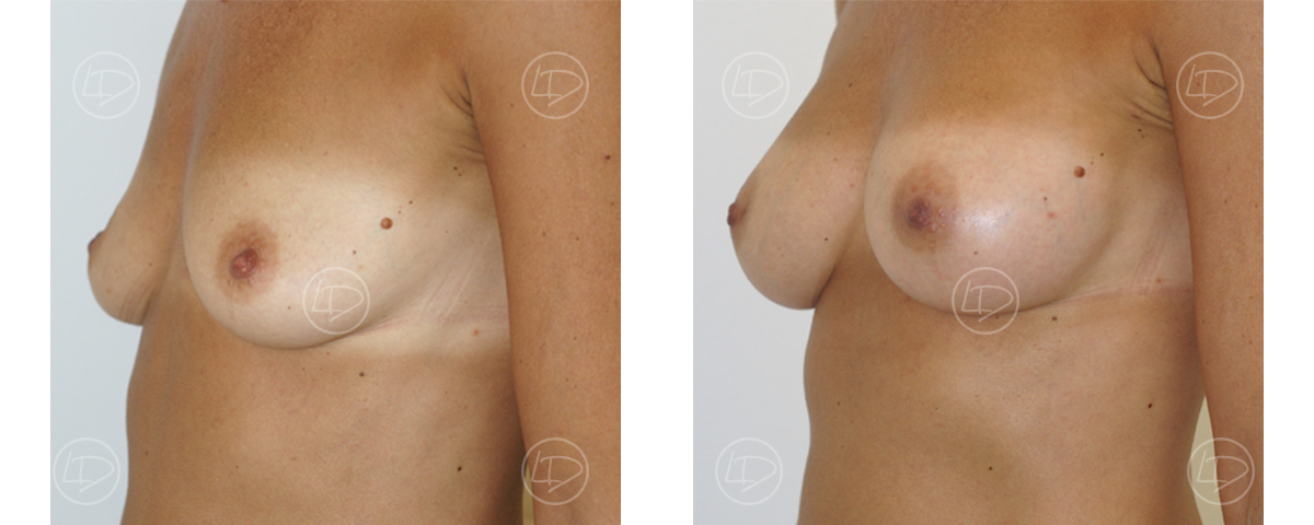 Photo d'une agmentation mammaire par prothèse avant et après