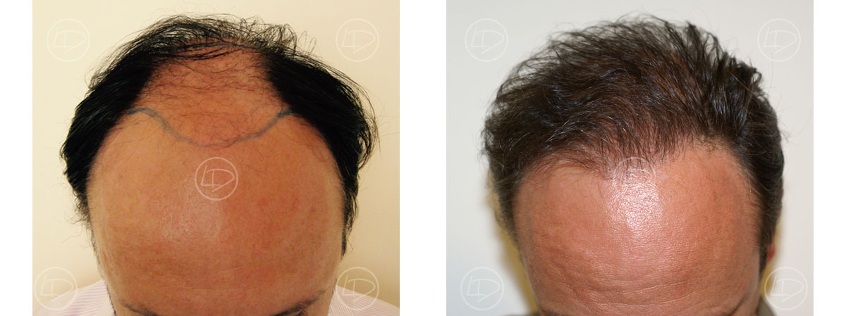 Photo de greffe de cheveux FUE avant / après : reconstitution de la ligne frontale